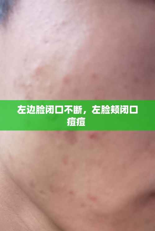 左边脸闭口不断，左脸颊闭口痘痘 