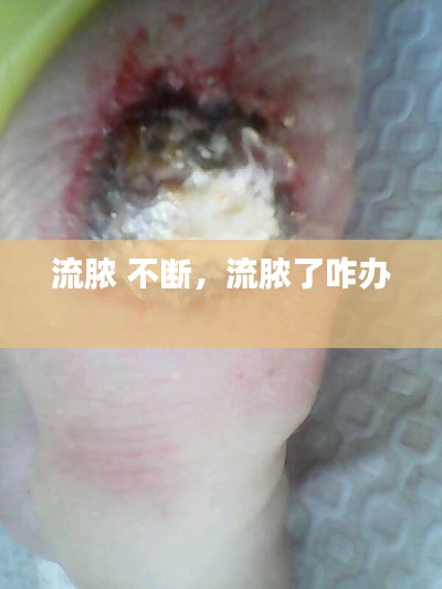 流脓 不断,流脓了咋办