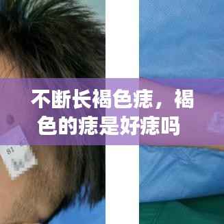 不断长褐色痣,褐色的痣是好痣吗