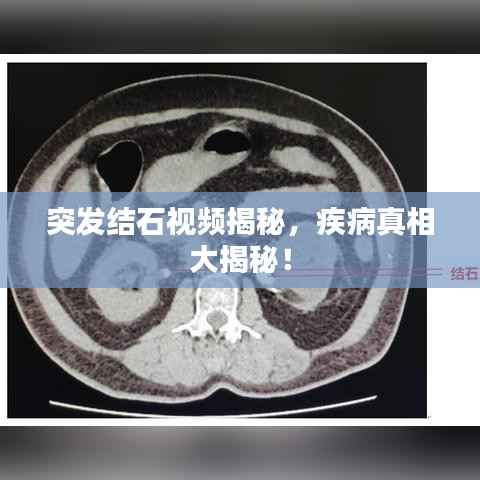 突发结石视频揭秘,疾病真相大揭秘!
